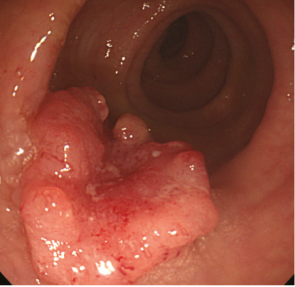 대장에 혹이 발견된 사진 - 대장암