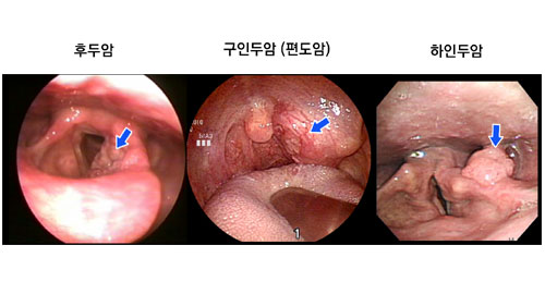 두경부암, 놓치면 위험! 조기 발견이 답이다 3 두경부암의 주요 종류