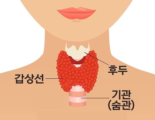 갑상선암 초기 증상 5가지와 자가 진단 방법 총정리 3 갑상선암 초기 증상 5가지와 자가 진단 방법 총정리