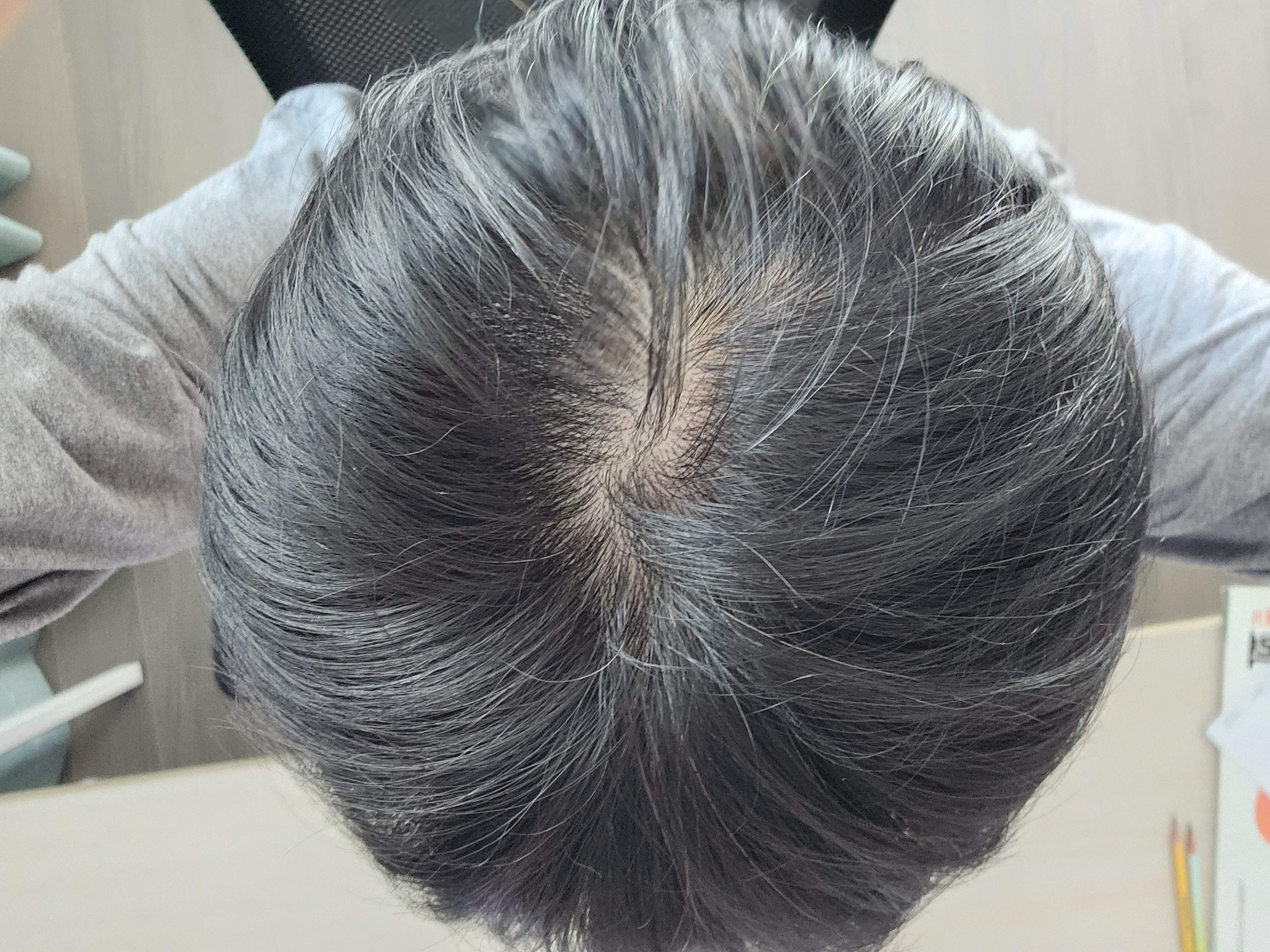 커클랜드 미녹시딜 5% 남자 탈모 쉐딩 3개월 후기 사용팁 (ft. 물파스공병, 마이모닉 가격) 11 ywAAAAAAQABAAACAUwAOw==