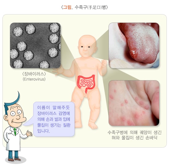 수족구병 완벽 가이드: 증상부터 예방까지 1 수족구병